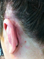 scaring above the ear after cochlear implant operation