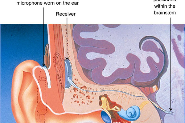 Diagram of Auditory Brainstem Implant (Courtesy of Cochlear Europe)