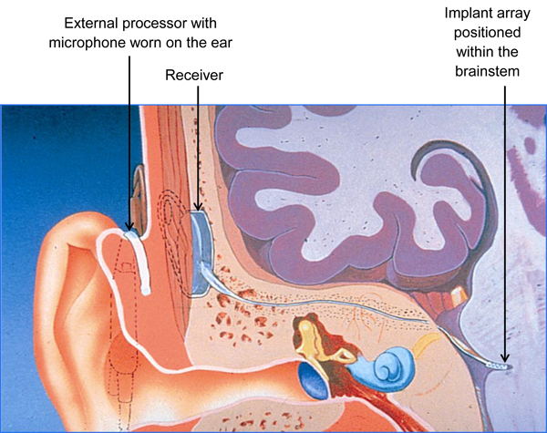 Labelled cutaway diagram of the human ear showing the placement of different components of an auditory brainstem implant. The external processor with microphone on the outer ear, with the receiver and brainstem implant array inside the ear