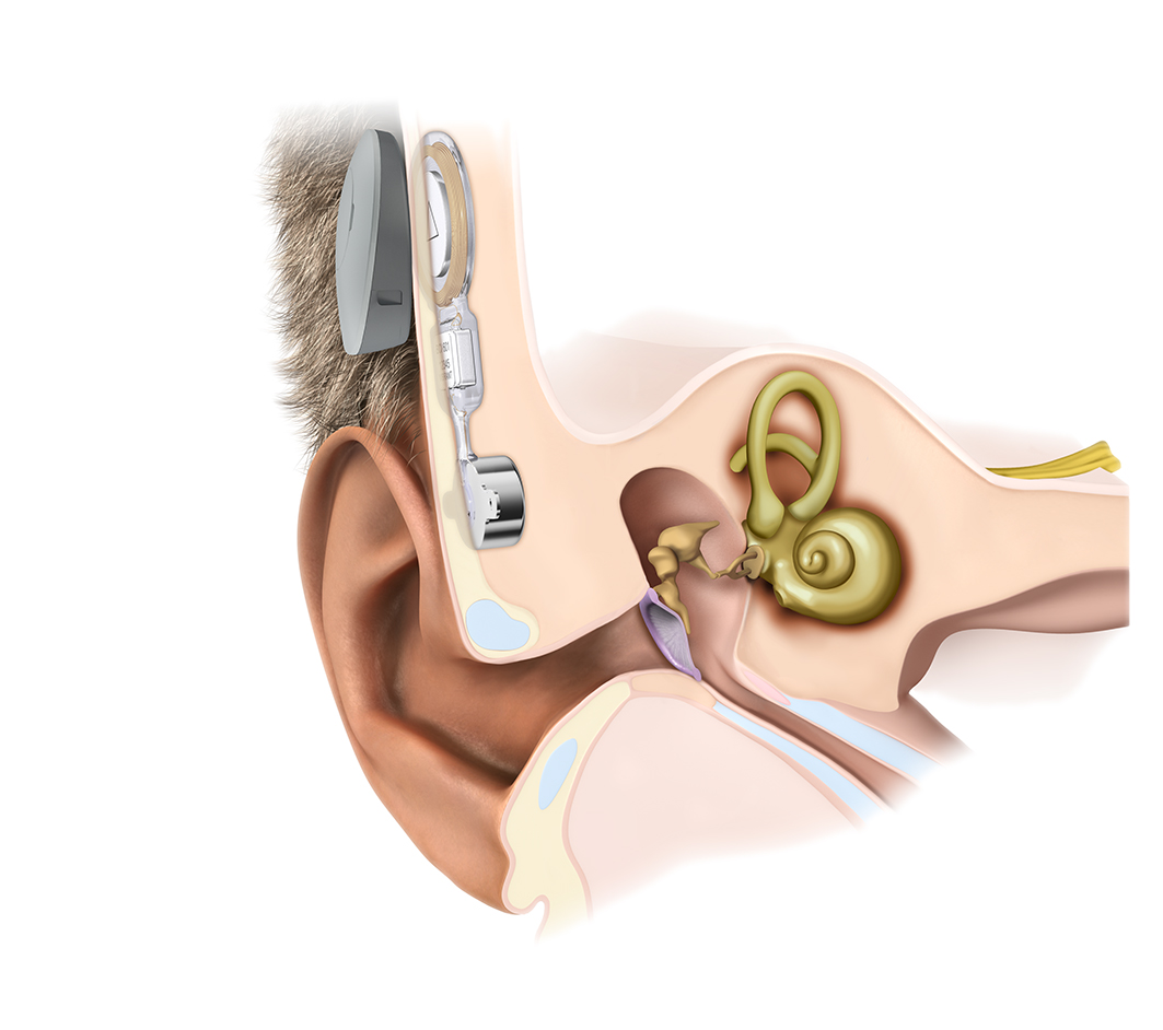 Diagram showing how a bone conduction hearing device works