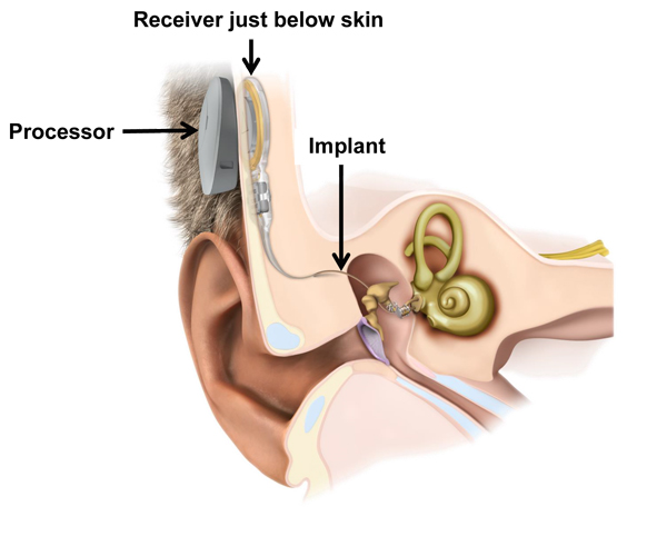 Diagram showing how a middle ear implant works