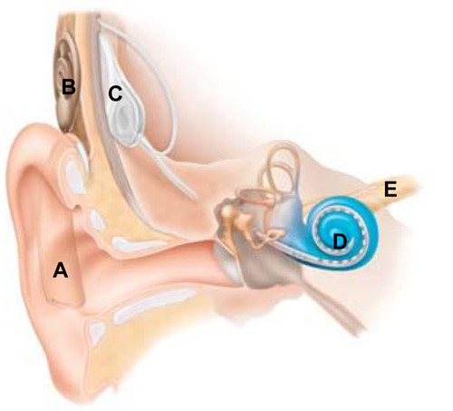 Cutaway diagram of an ear showing how the different parts of a cochlear implant are placed 